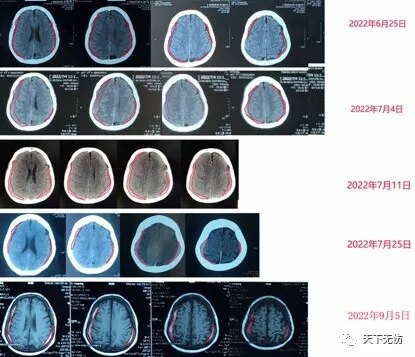 將關懷揉進細節中_硬腦膜下血腫_硬腦膜下血腫治療方式 - 好大夫在線