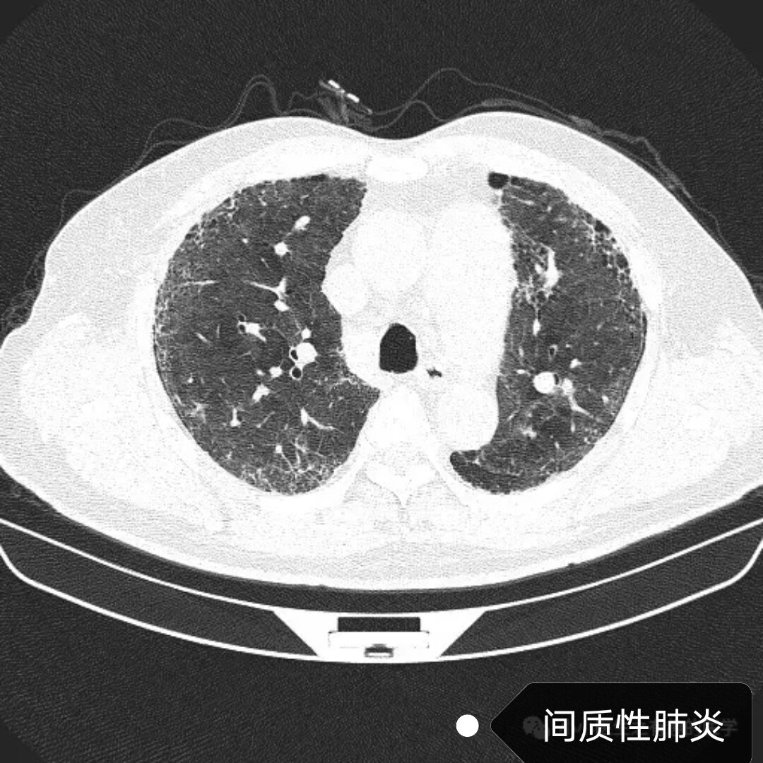 血管炎间质性肺炎图片