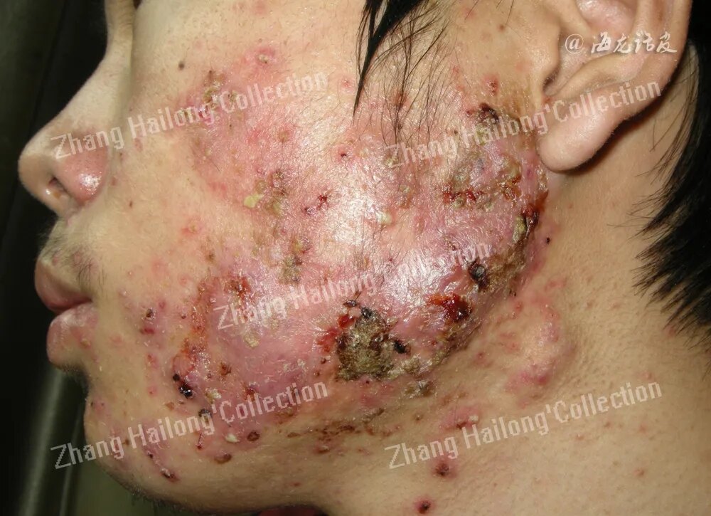 痤疮丙酸杆菌在寻常痤疮发病中的作用及其机制_痤疮_发病原因_症状