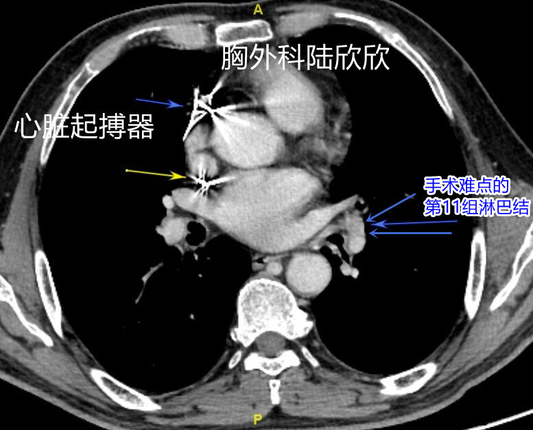 11组淋巴结和起搏器水印.jpg