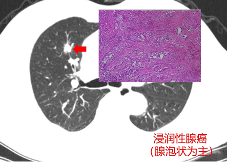 肺結節之三實性結節篇