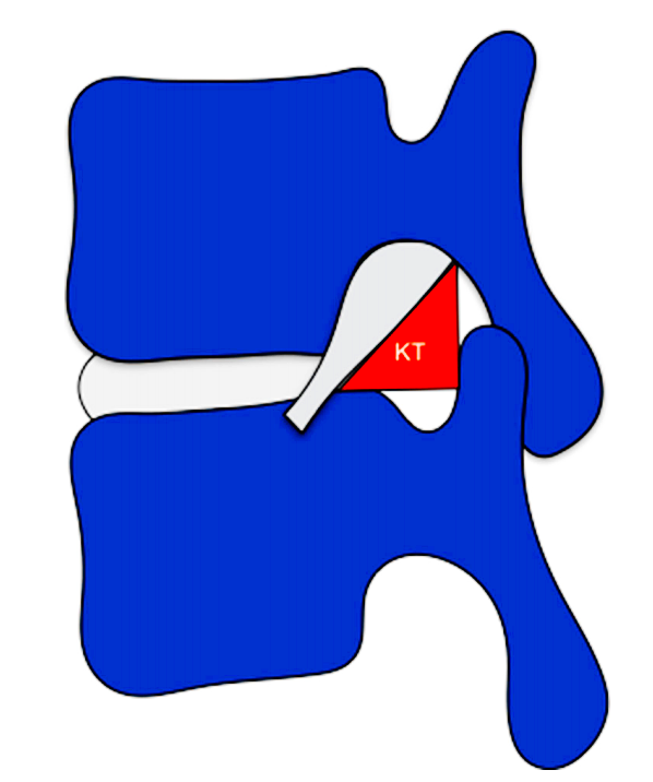 disc,ivd)后外侧角的安全区——kambin三角(图1)