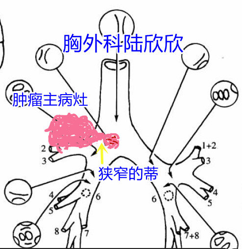 支气管解剖图肿瘤.jpg