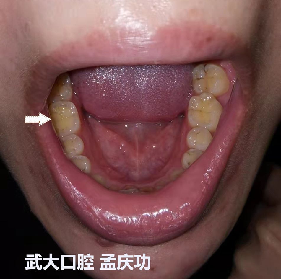 磨牙表现为牙齿异常磨耗明显,尤其是磨牙的牙尖,变平消失,牙本质暴露