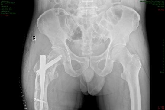 癌症怎么才能转移到骨头的 14YBAGfv10KALxjqAABHoG7SQC086.jpeg?_ms_=a167