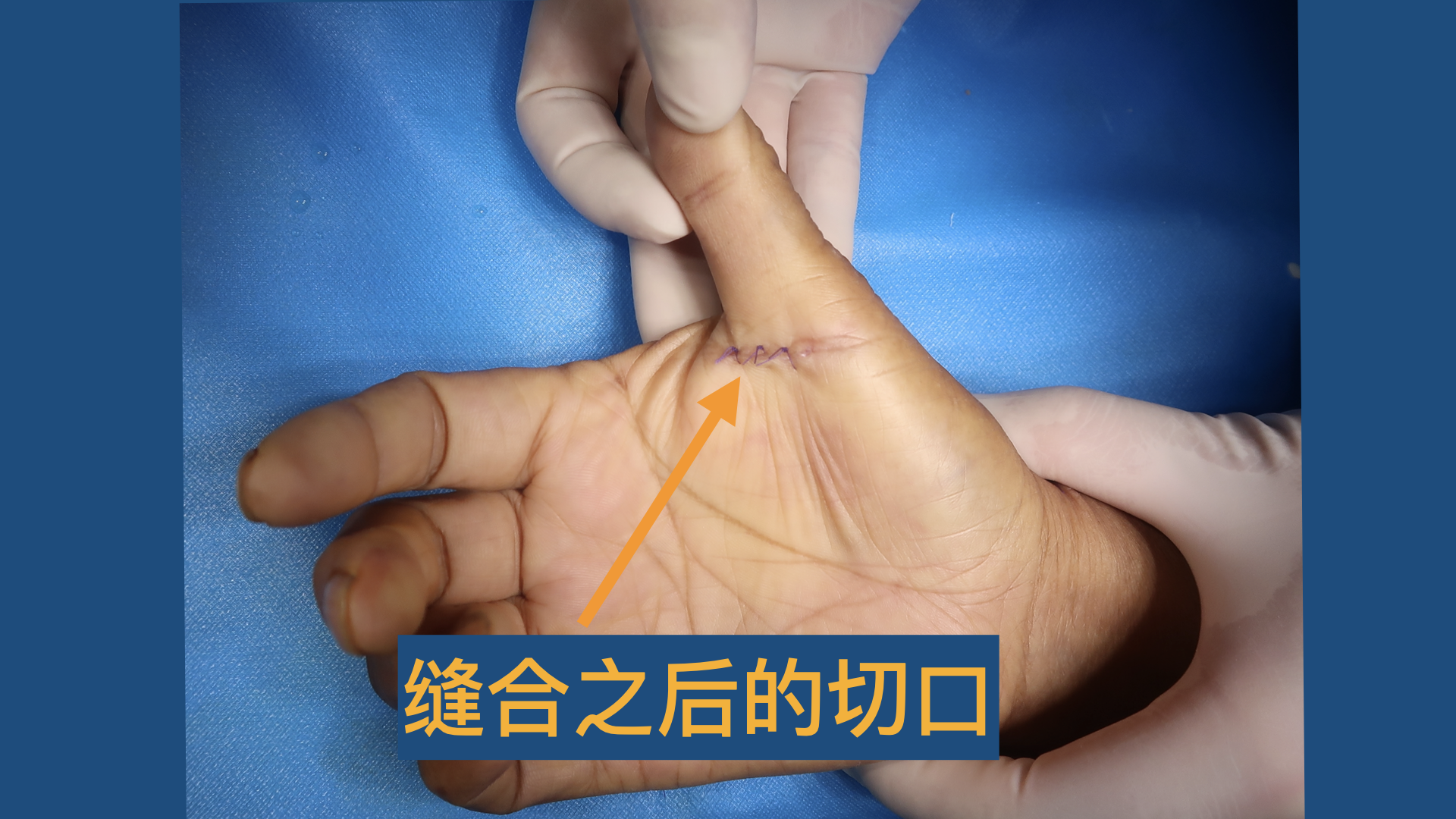 拇指腱鞘切开术图片图片