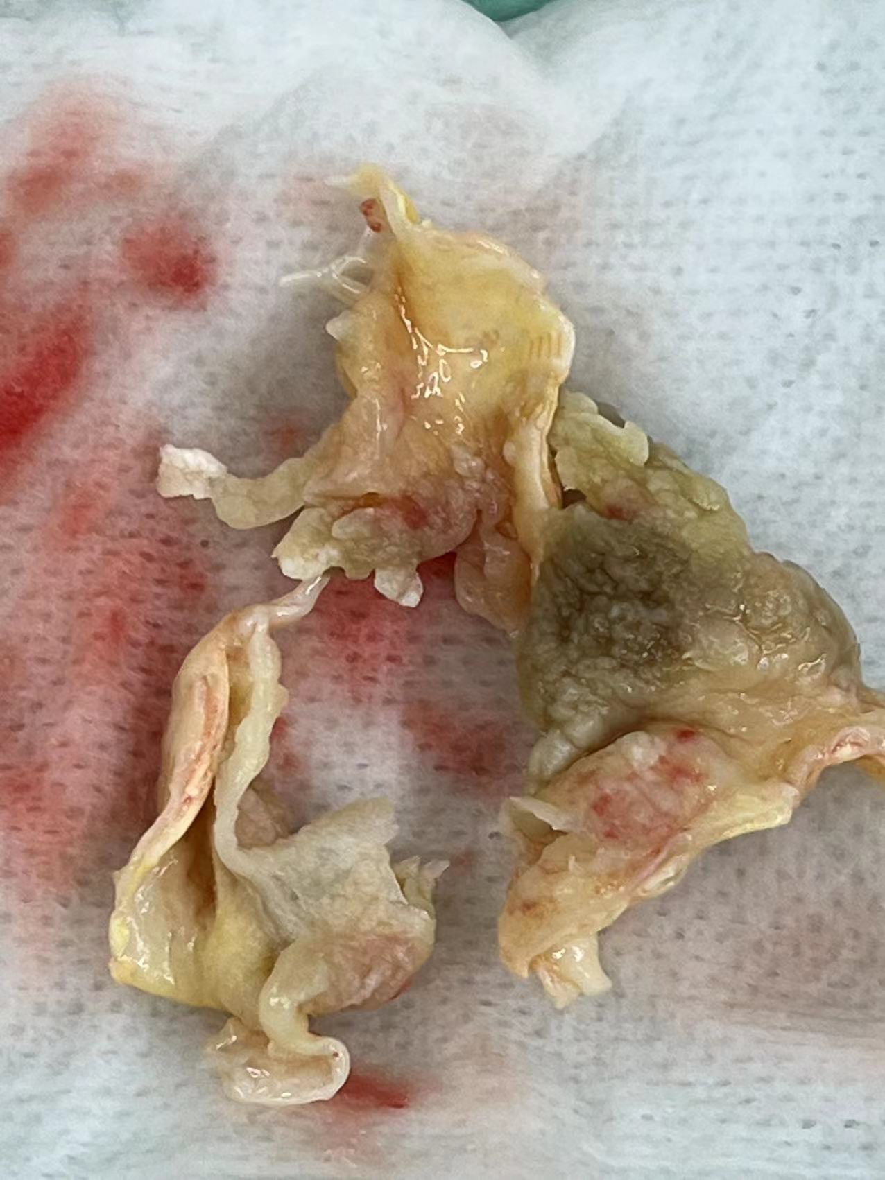 急诊手术抢救一例重症感染性心内膜炎患者_感染_相关疾病_治疗方式