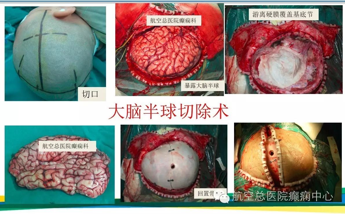 额叶切除手术废除_额叶切除手术_额叶手术切口