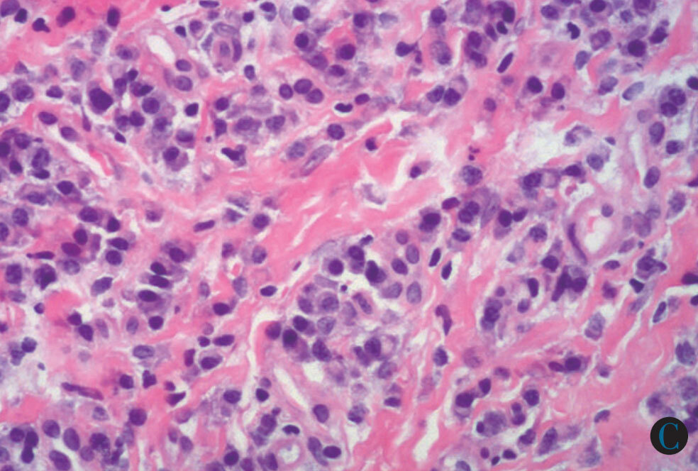 得了「浆细胞性包皮龟头炎」别着急,看这文章就清楚了 - 好大夫在线