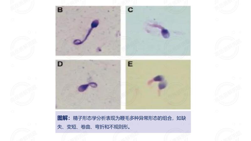 图：精子鞭毛多发形态异常镜下表现.jpg