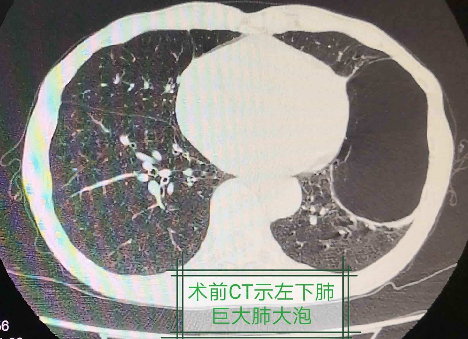 消失的肺大泡內科微創成功治療巨大肺大泡