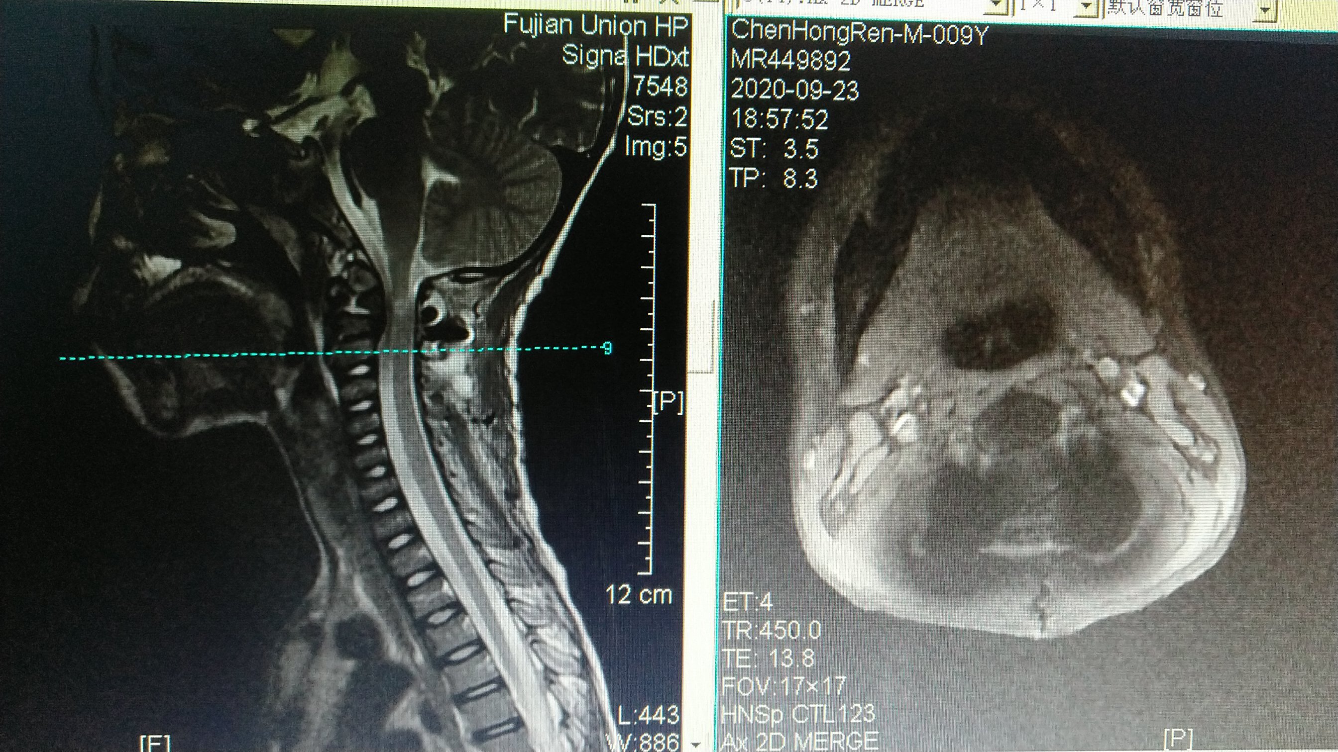儿童寰枢椎半脱位表现图片