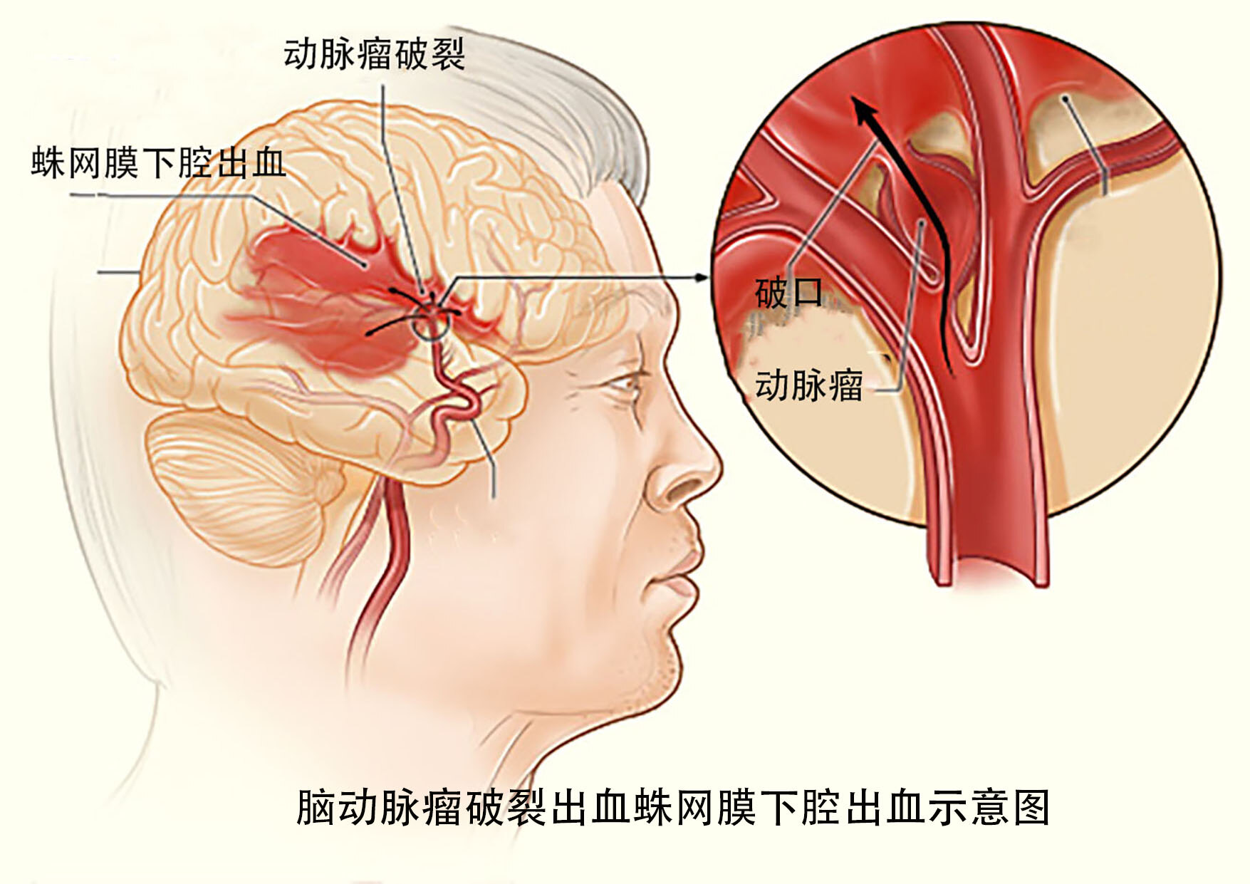 脑动脉瘤颅内动脉瘤会出现什么症状