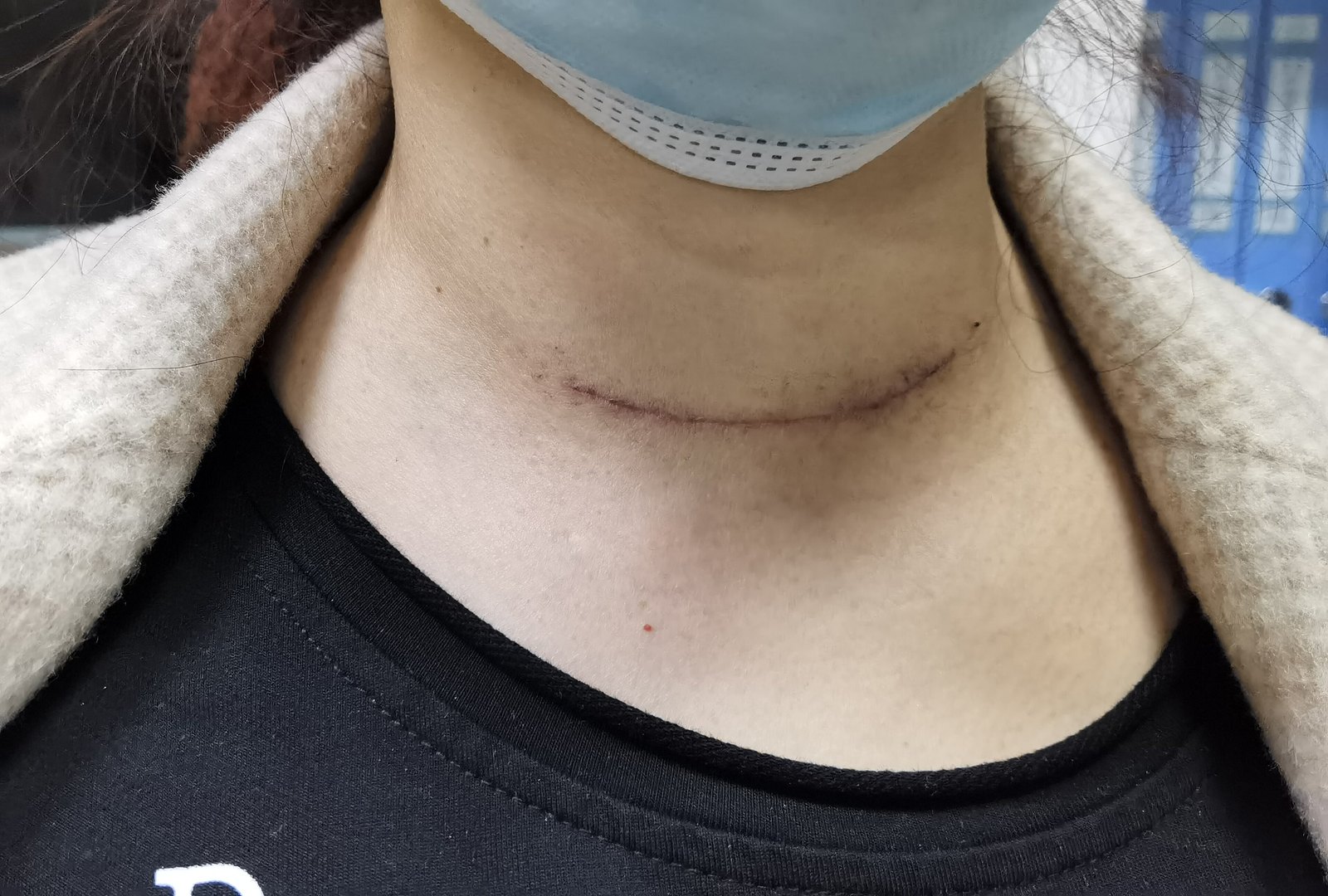 颈部切口美容缝合