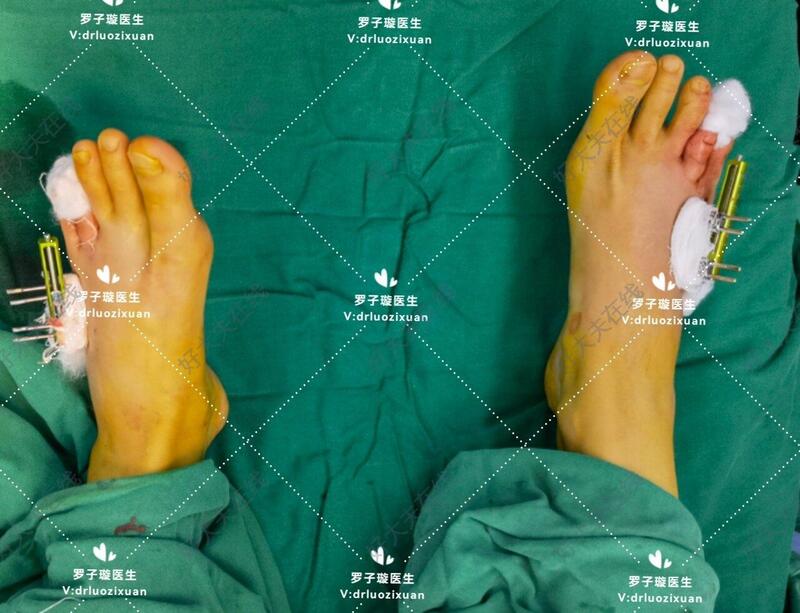 实际上短趾症并不真的指脚趾短,而是指跖骨短小甚至消失