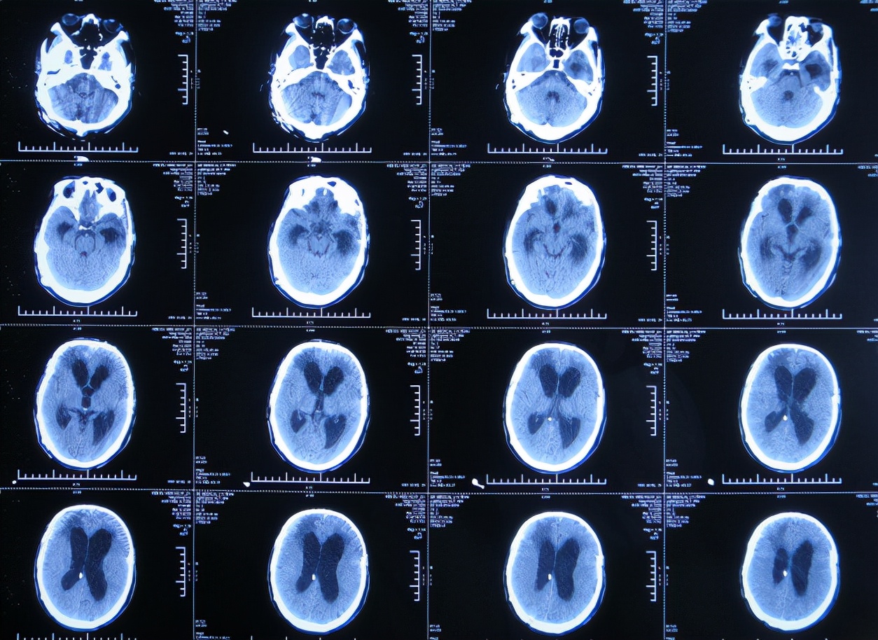 在第3家医院康复治疗近1个月时间内,曾4次查头颅影像(2020年1月22日