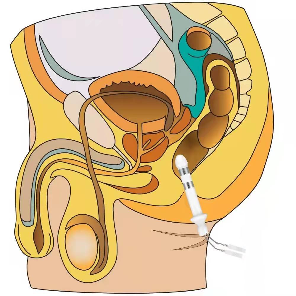 临床研究认为,由于长期尿液返流所造成的尿道前列腺部及精阜,前列腺腺