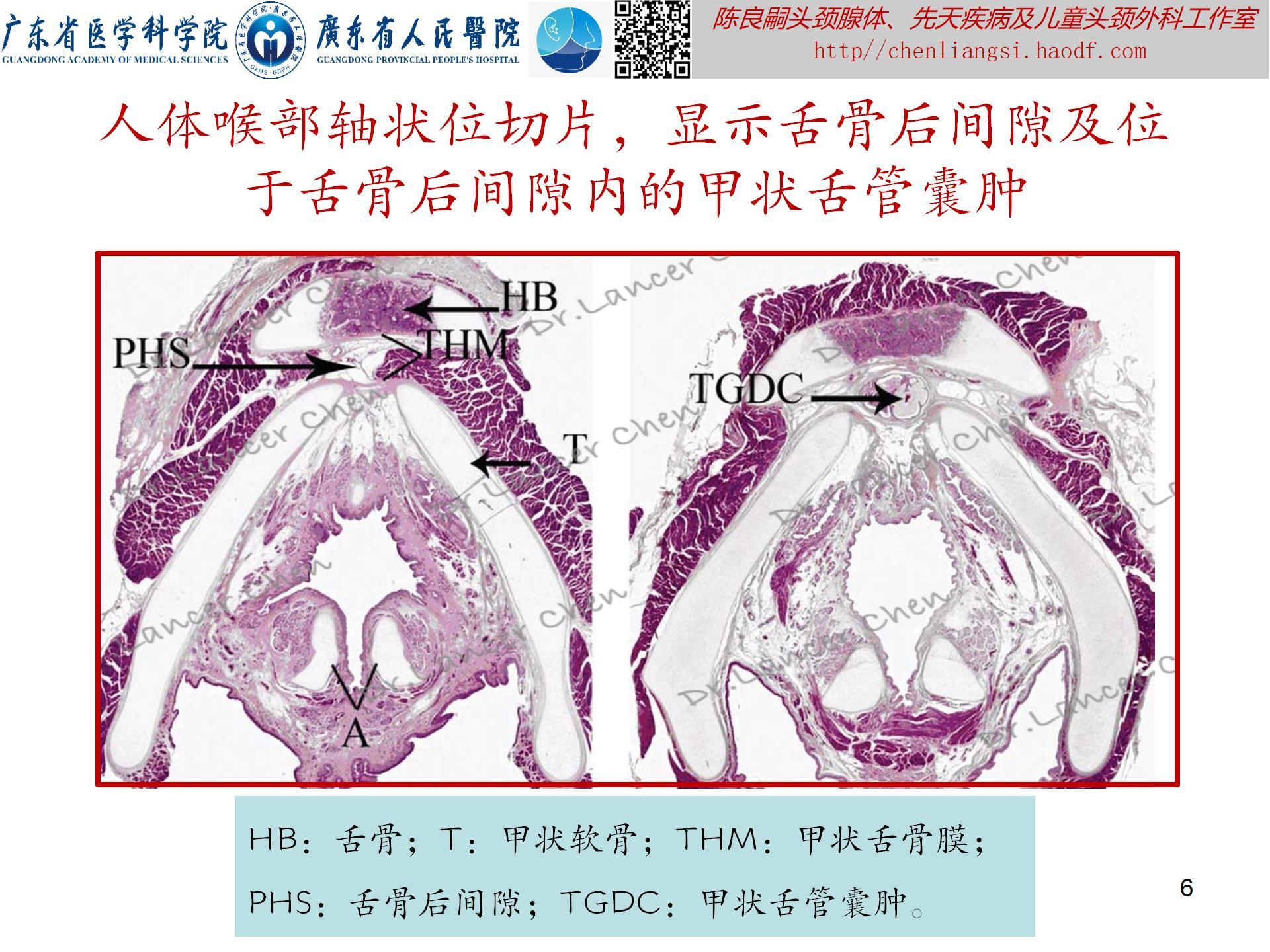 20240621：医学科普——百密一疏：舌骨后间隙的忽略，可导致甲状舌管囊肿术后复发_06.jpg