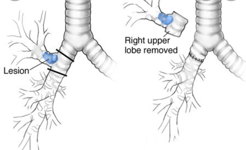 肺袖状切除术示意图图片