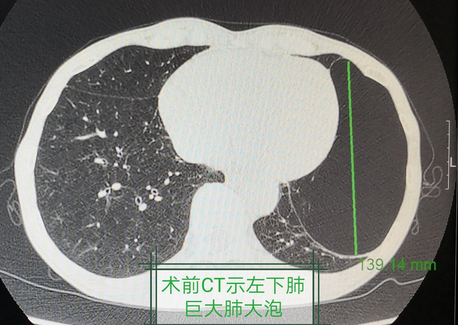 消失的肺大泡內科微創成功治療巨大肺大泡