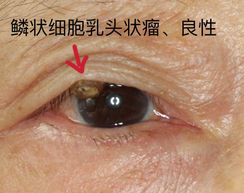 眼睛肿瘤小敏图片图片