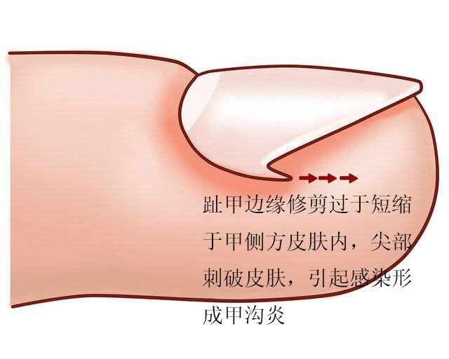 甲沟炎_甲沟炎_介绍_症状表现_如何预防_治疗方式 - 好大夫在线