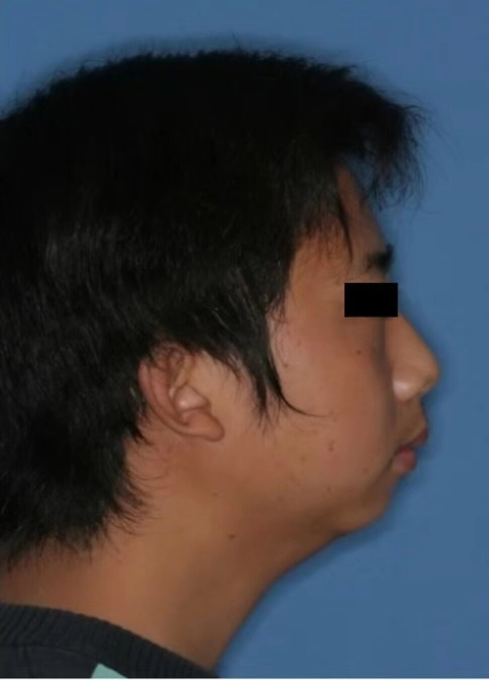 小儿腺样体肥大_症状表现_治疗方式 - 好大夫在线