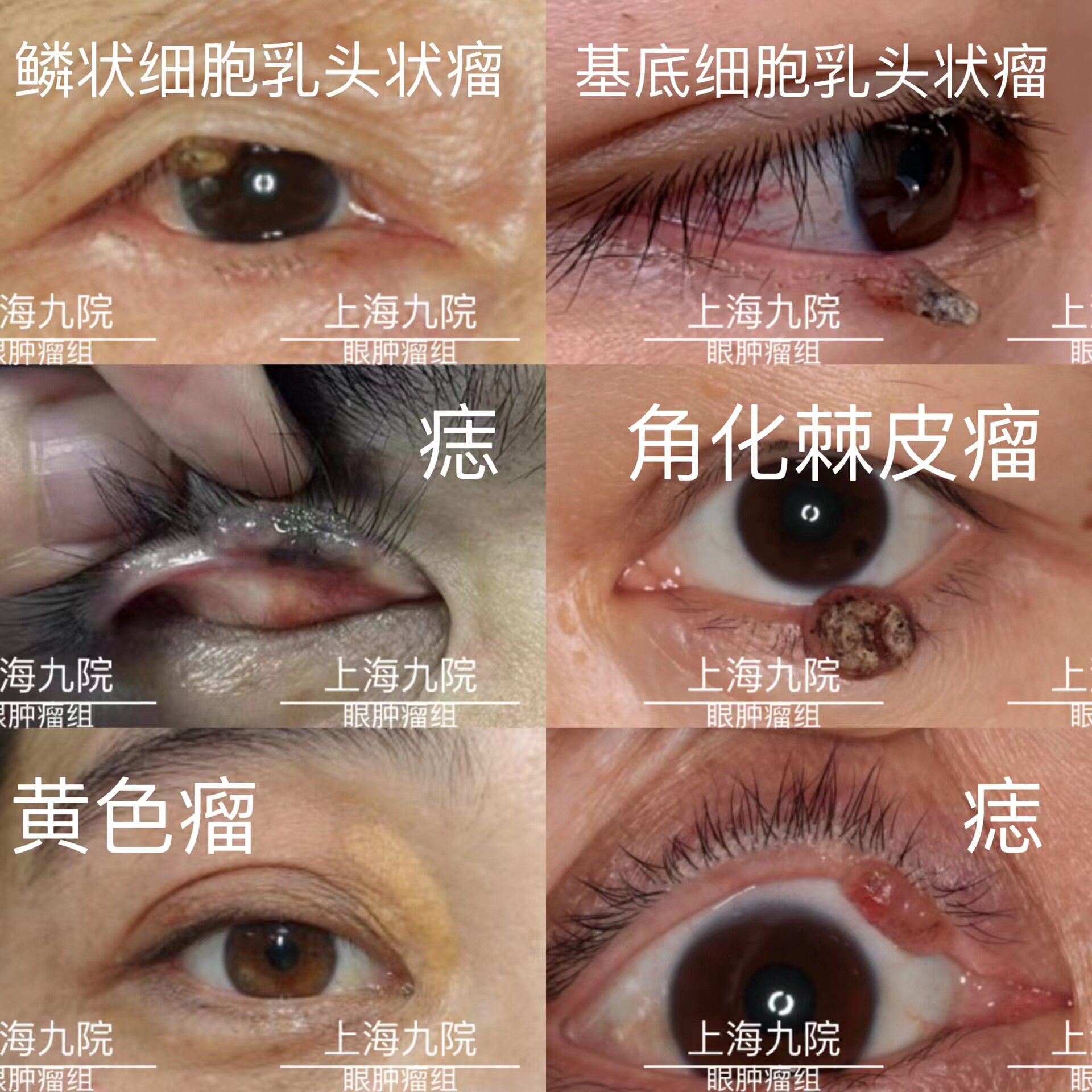 常见眼肿瘤类型及图谱