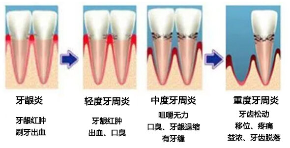 牙周炎可以引起脑血栓吗?_牙周炎_牙周炎介绍 - 好大夫在线