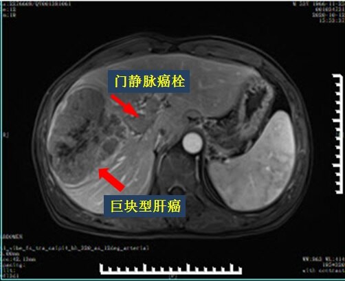 故事5晚期肝癌伴門靜脈癌栓碘125粒子條使門靜脈血流再通