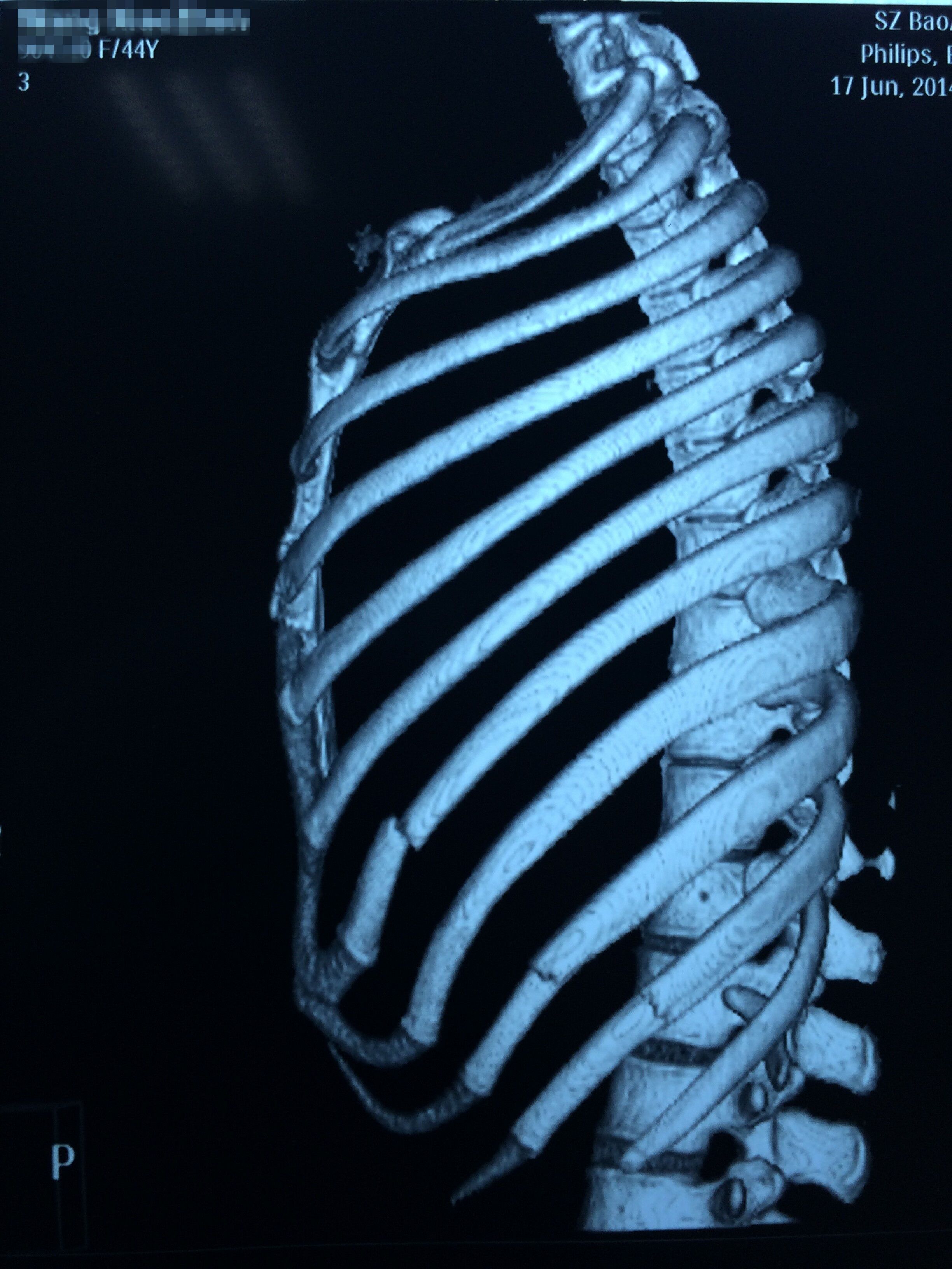 隐匿性肋骨骨折 肋骨骨折 隐匿性肋骨骨折 肋骨骨折