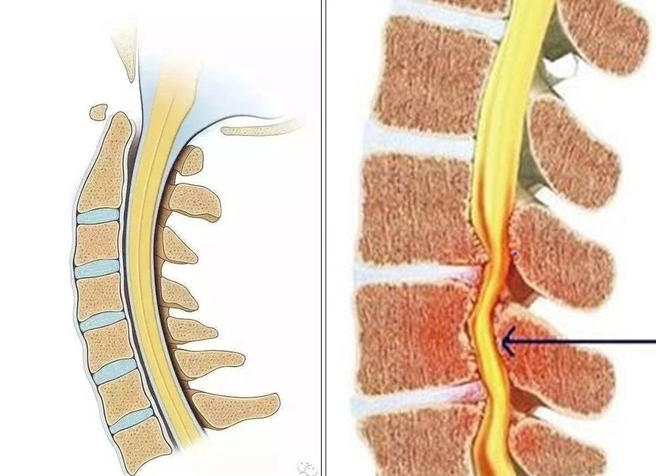 脊髓型颈椎病图片高清图片