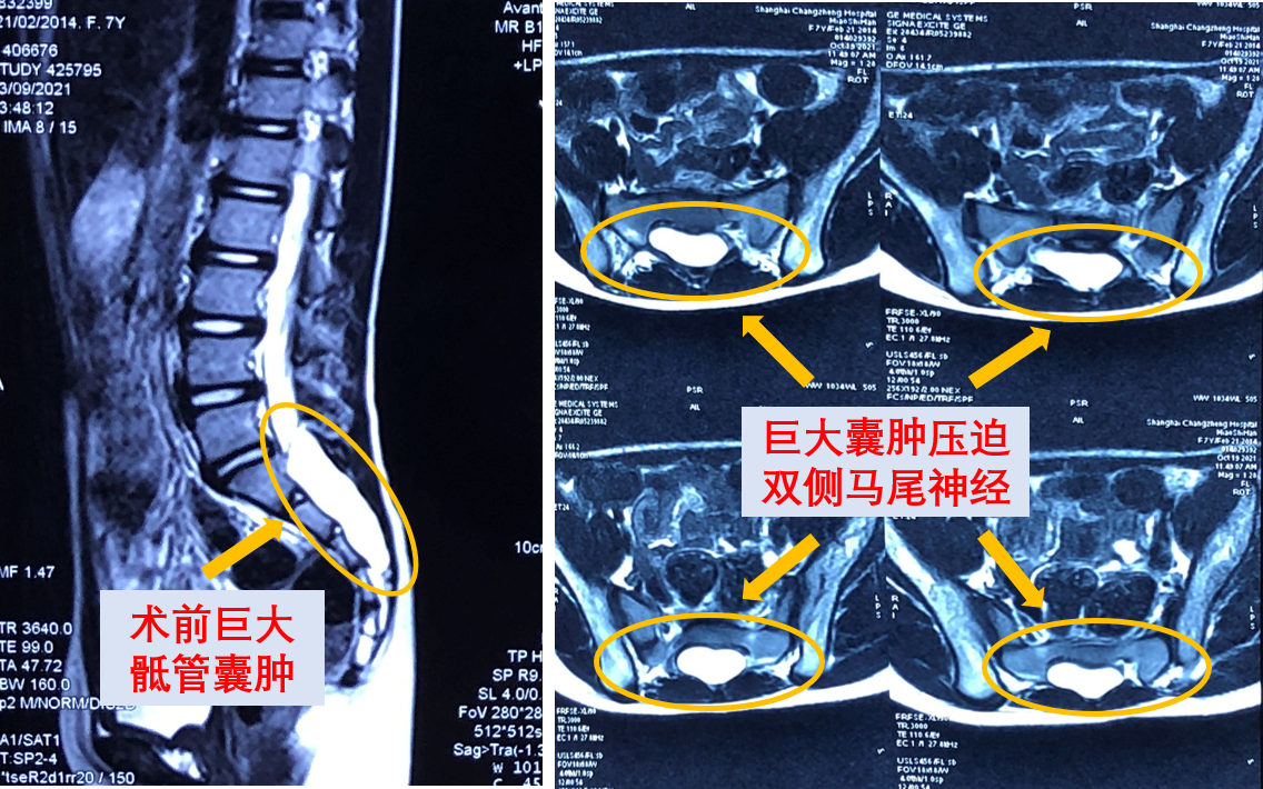 腰椎骶管囊肿图片图片