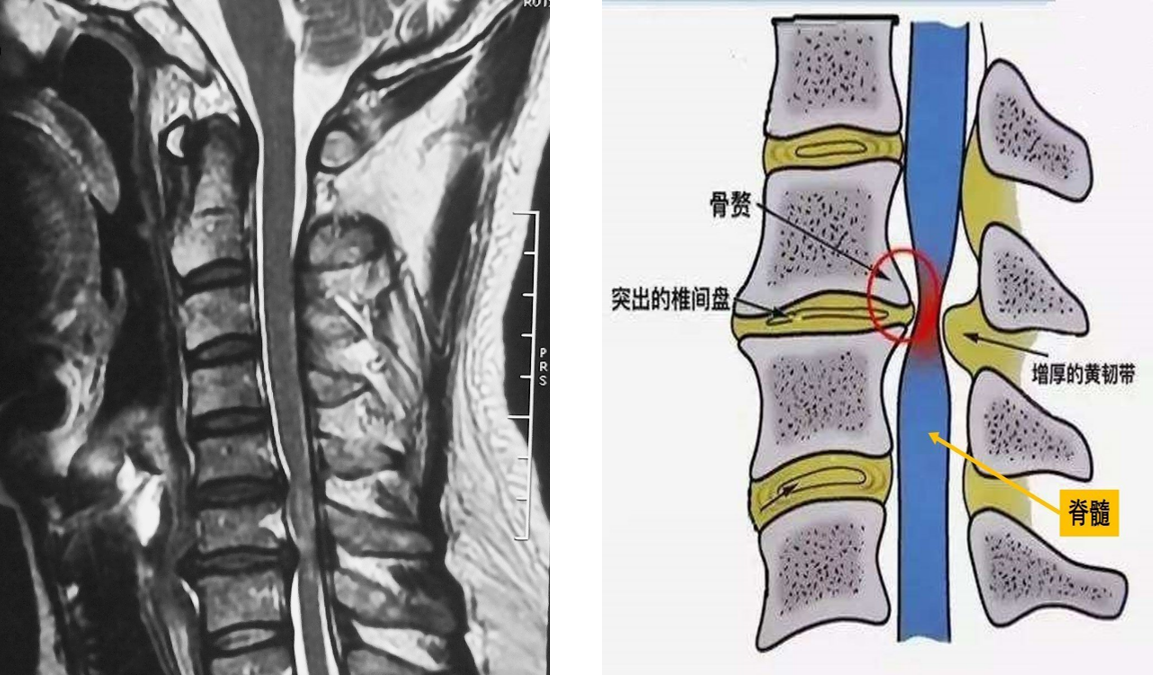 脊髓型<!--HAODF:8:jingzhuibing-->颈椎病<!--HAODF:/8:jingzhuibing-->.png