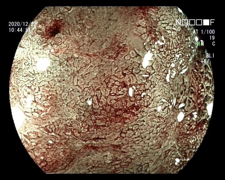 胃癌胃镜图片 彩色图片