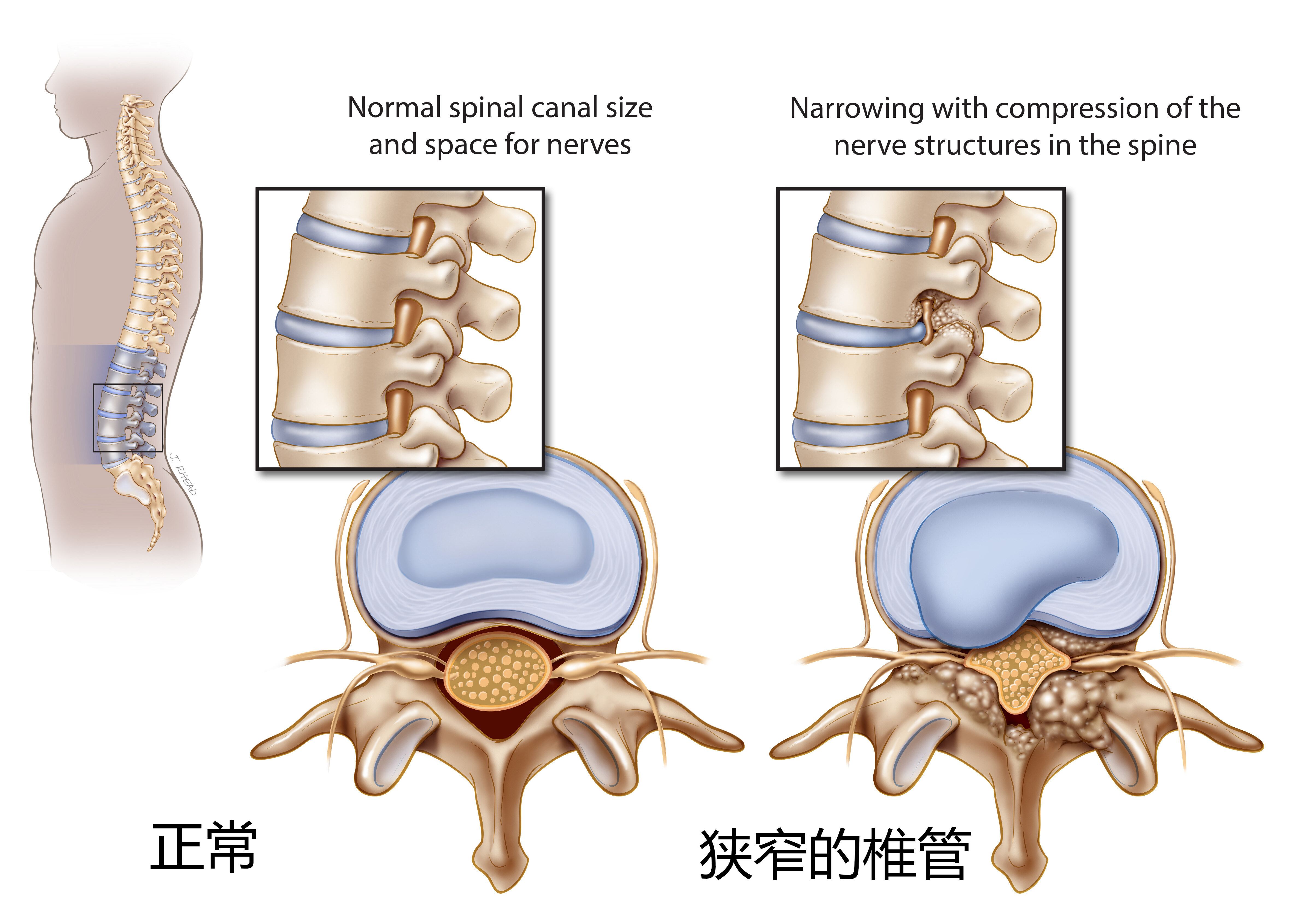 腰椎椎管矢状径图片