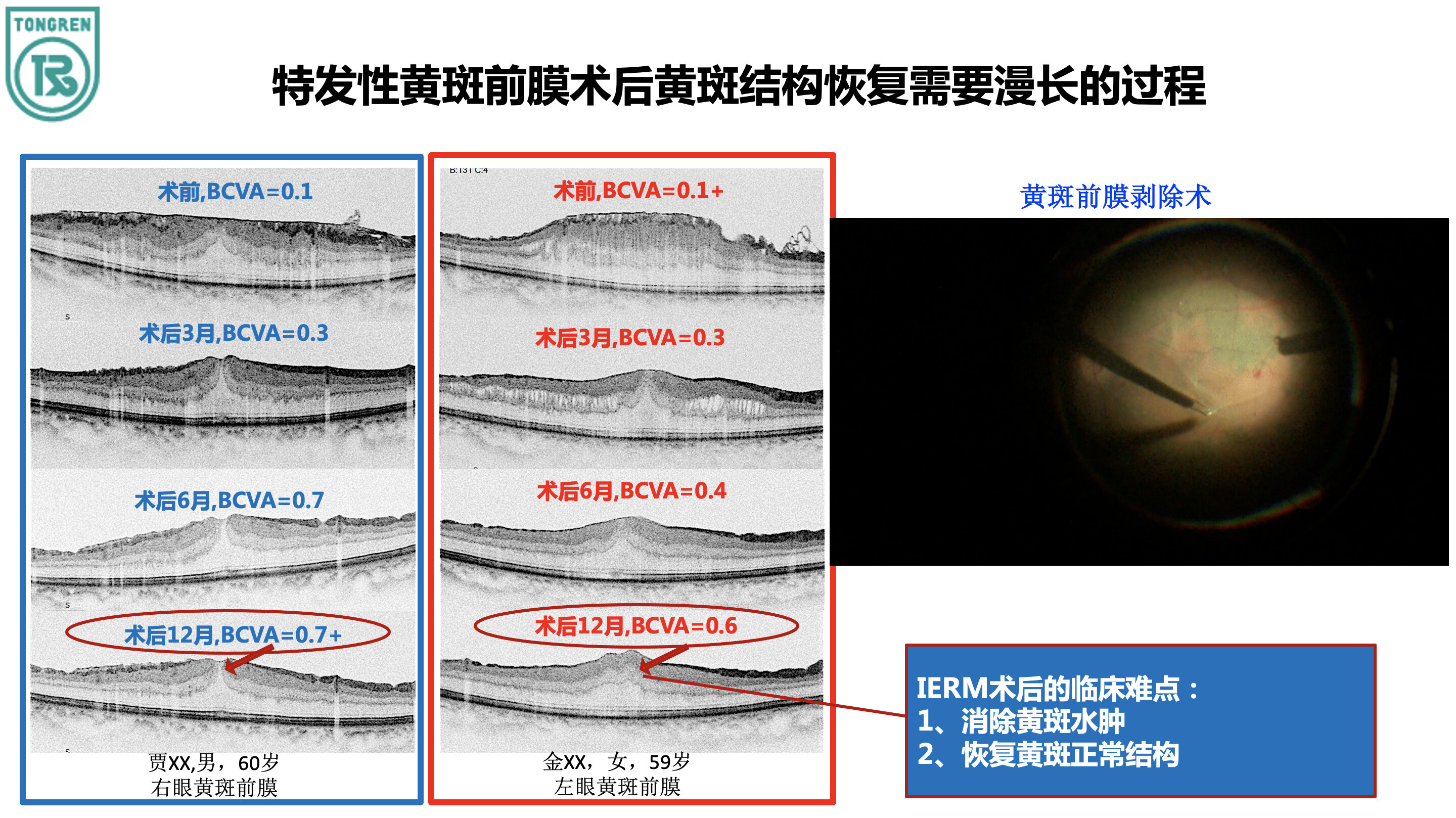 IERM手术效果.jpg