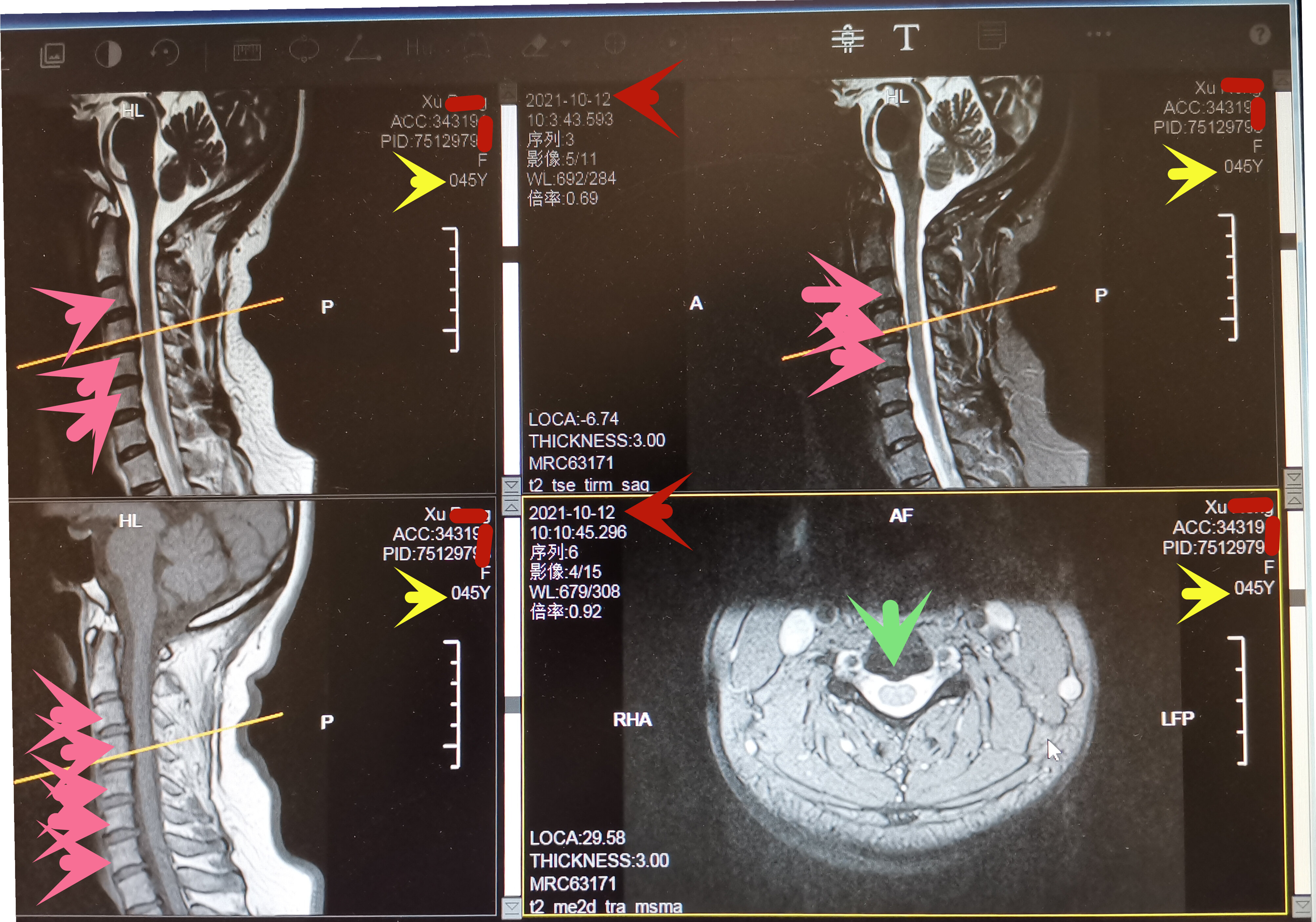 20211012徐蓉颈椎mri