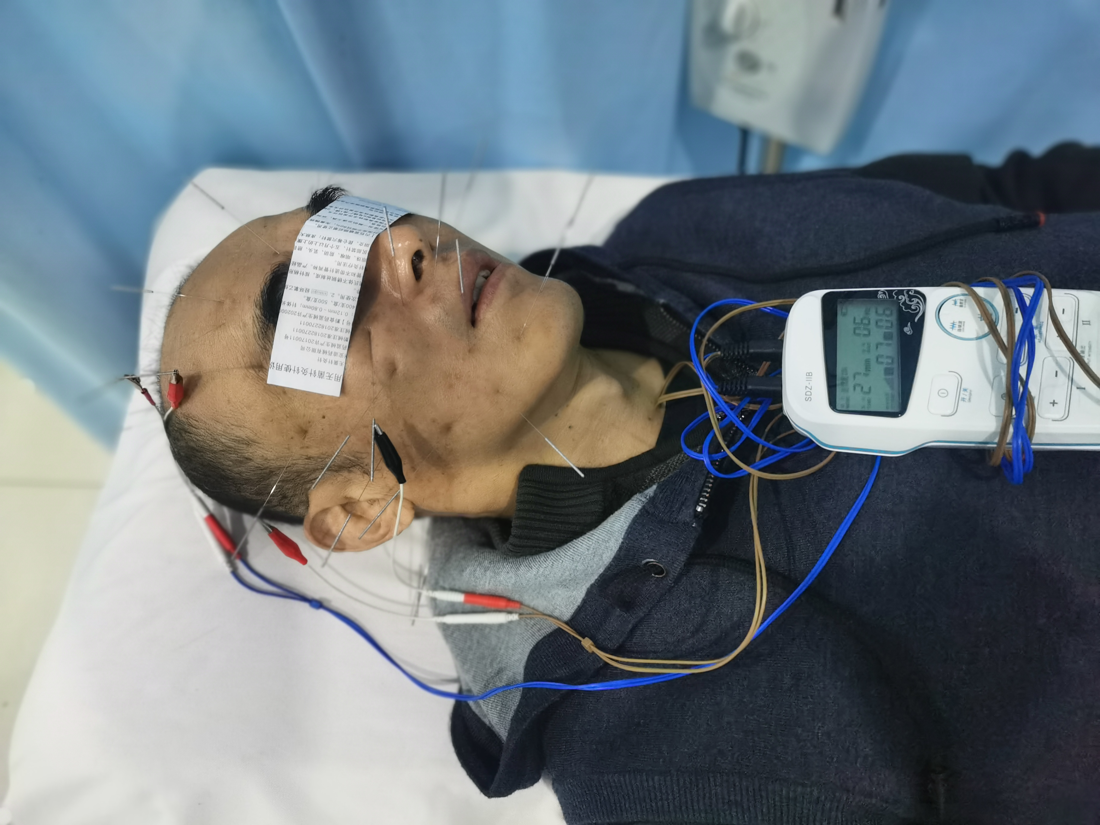 安军明主任医师电针治疗听神经瘤术后眼睑闭合不全案一则 - 好大夫