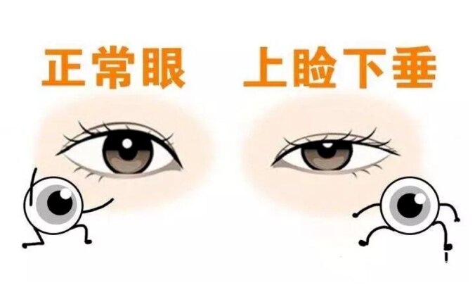 开眼角是什么病 2YYBAGW_bbaAXvKMAABv4dtv0zA696.jpg?_ms_=5255