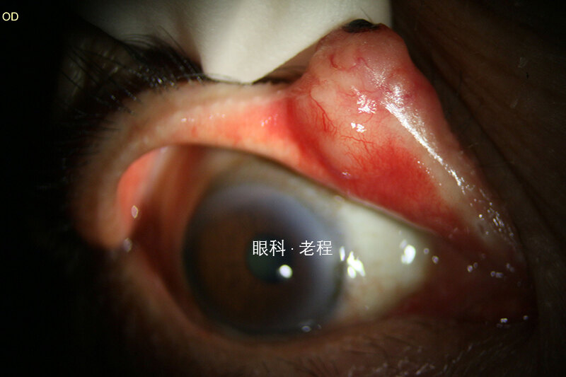 结膜鳞状细胞癌图片图片