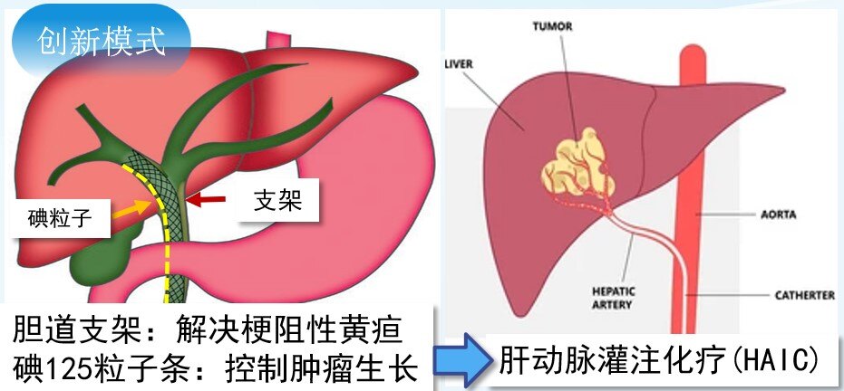 CSTENT-1.jpg