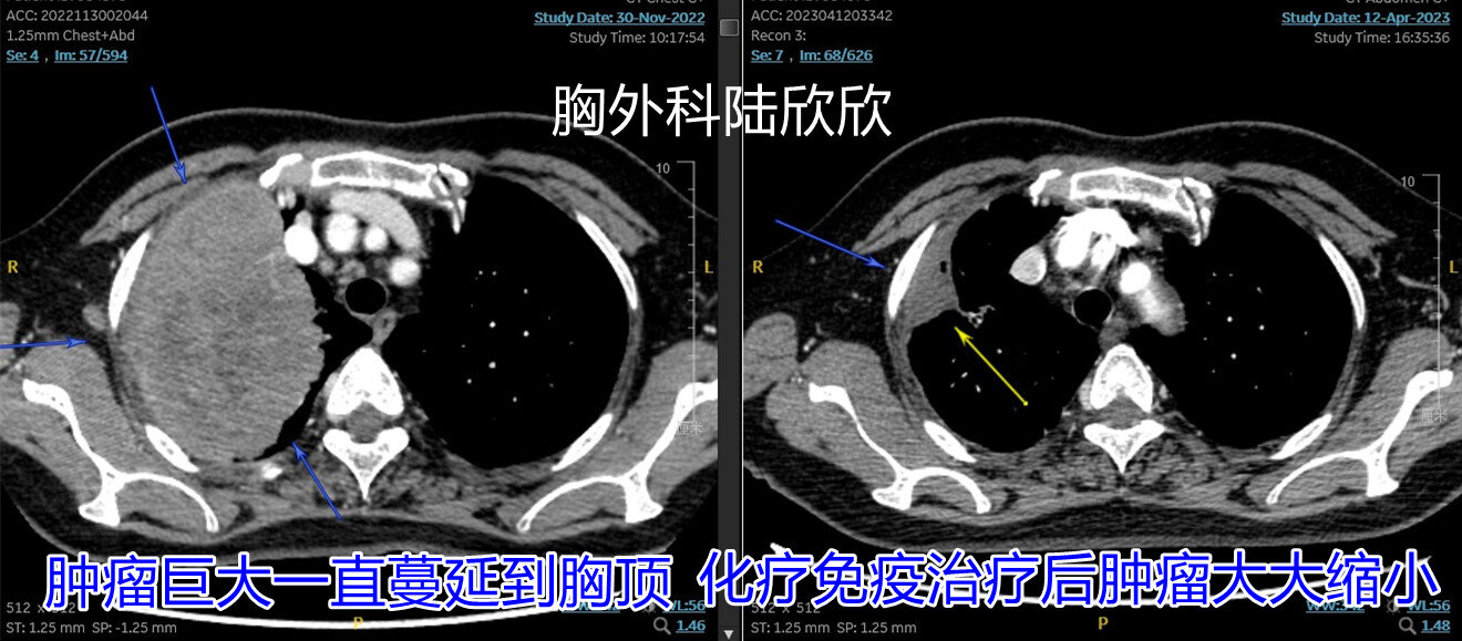 胸顶层面的肿瘤明显缩小 - 副本.jpg