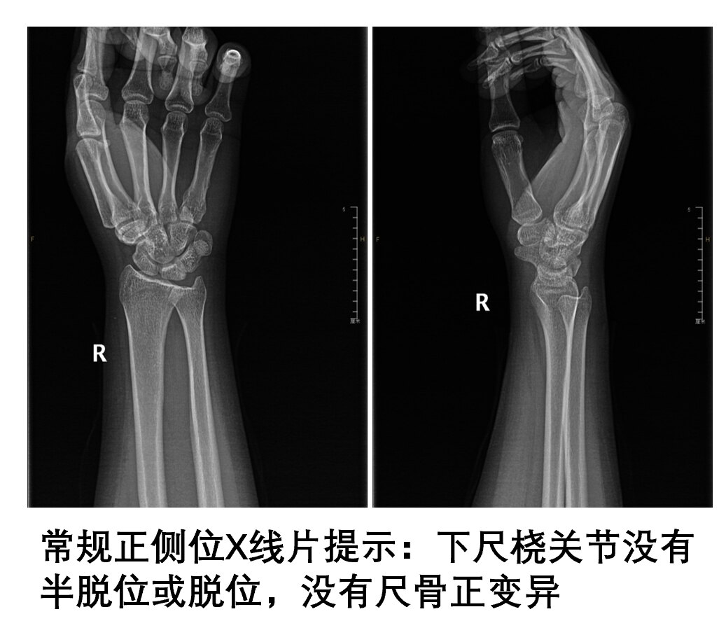 腕背屈角度图片