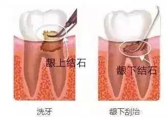 怎么去除牙结石和菌斑 2oYBAGVhl2iABbGkAAArL8AeItg568.jpg?_ms_=ec89