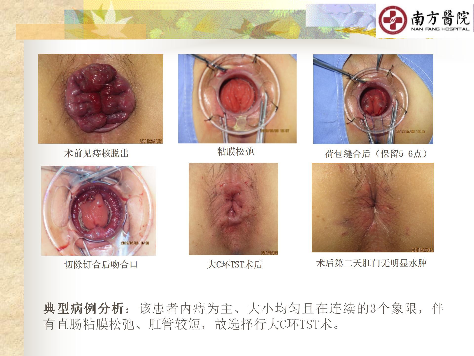 痔的精准化规范化微创化治疗之痔脱出1_24.jpg