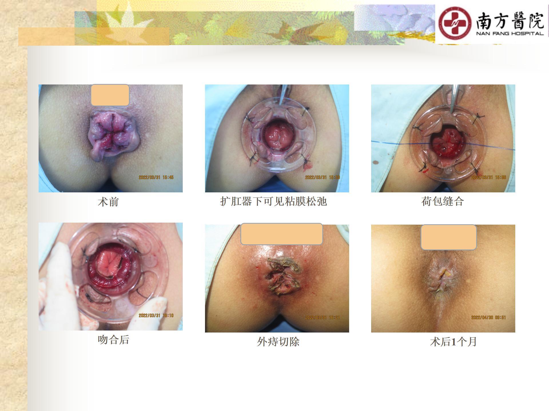 痔的精准化规范化微创化治疗之痔脱出2_17.jpg