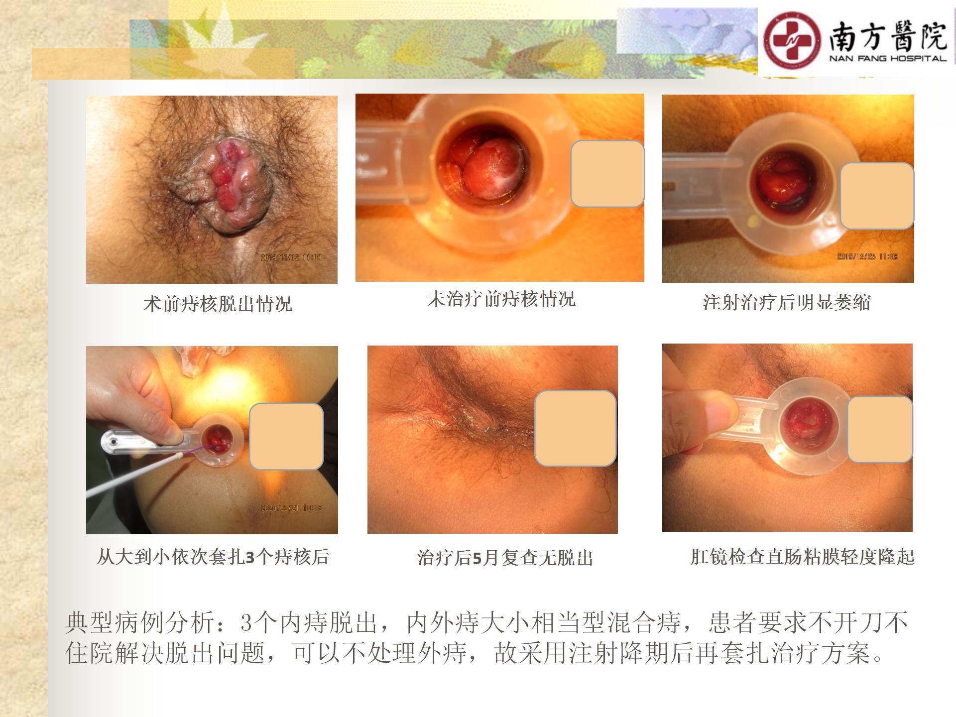 痔的精准化规范化微创化治疗之痔脱出2_13.jpg