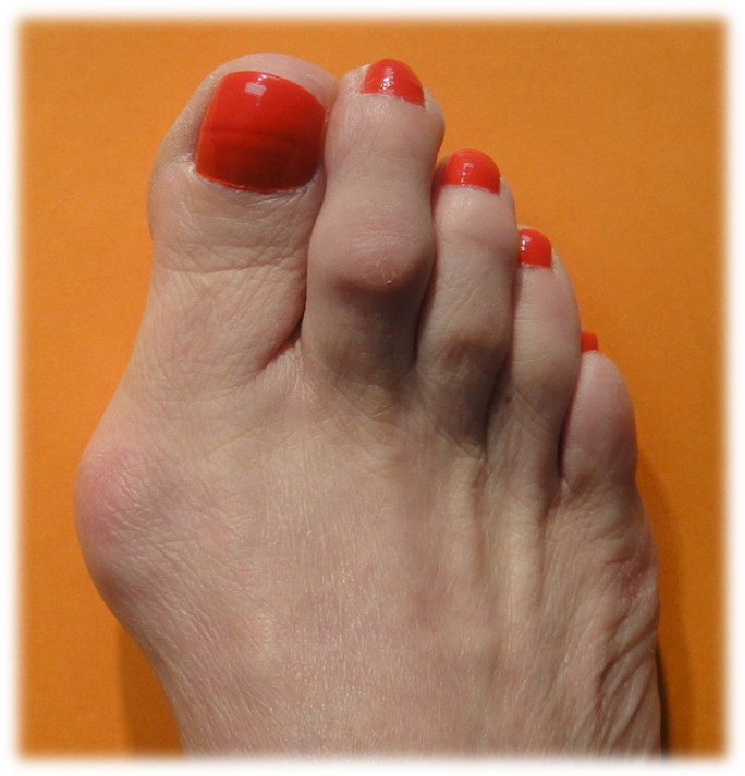 微创美足治疗大脚骨