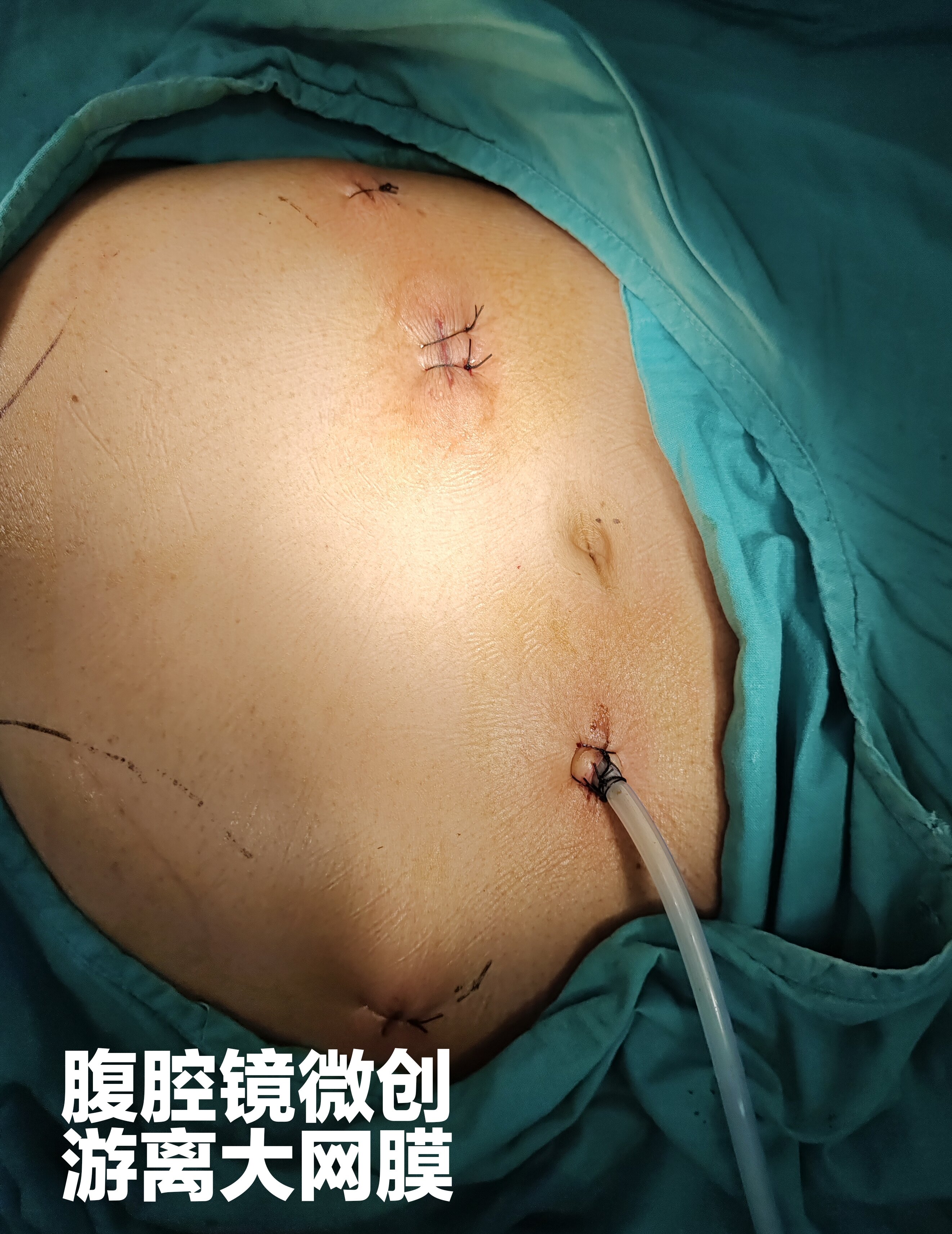 右全肺胸壁结核巨大残腔大网膜填充一次治愈